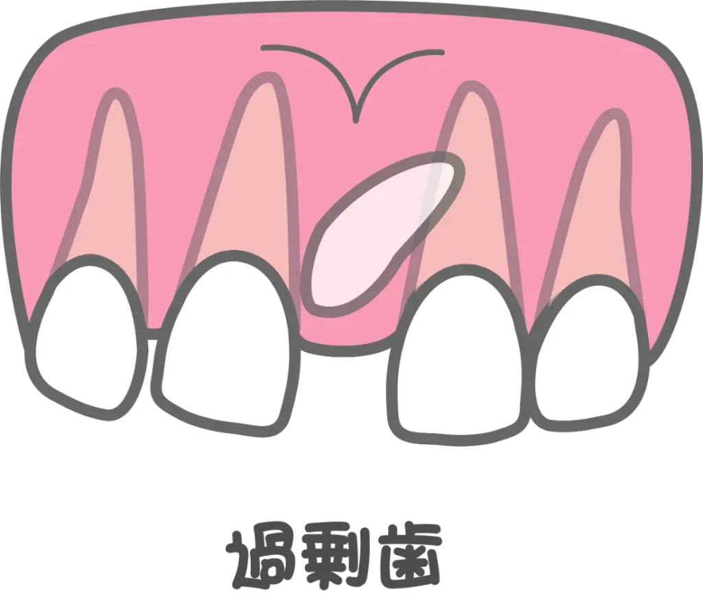 過剰歯