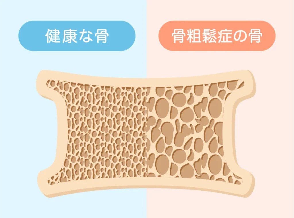 骨粗しょう症④