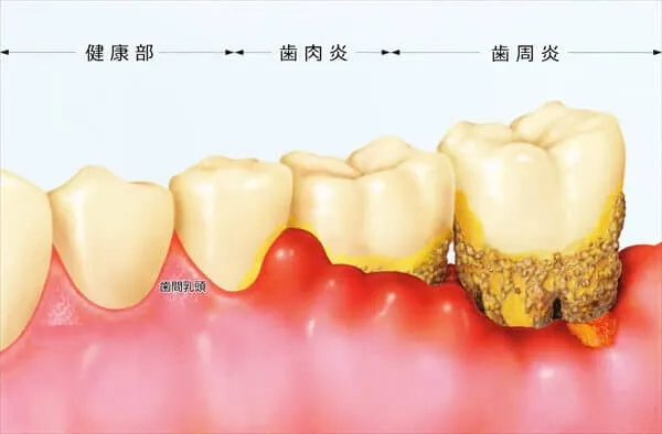 歯肉炎と歯周炎の相違点