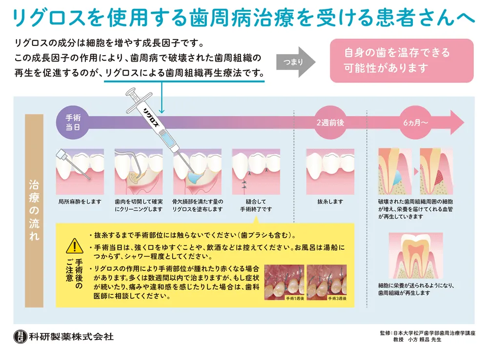 歯周組織再生療法の概要