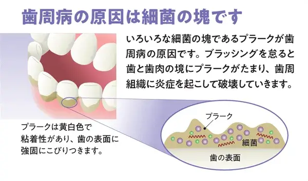 歯周病の原因は細菌の塊です