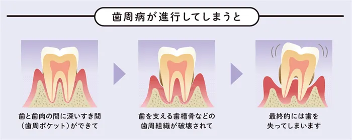 歯周病の進行イメージイラスト