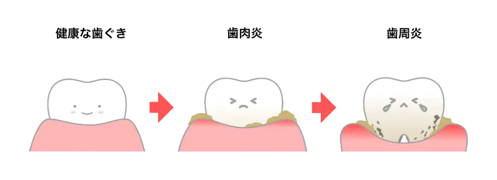 妊娠性の歯周炎