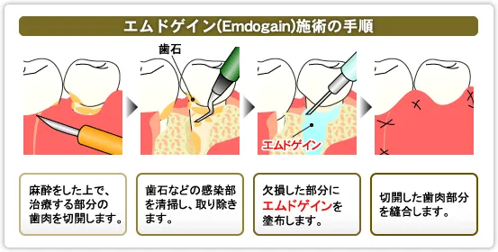 エムドゲイン