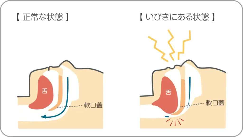 舌根沈下②