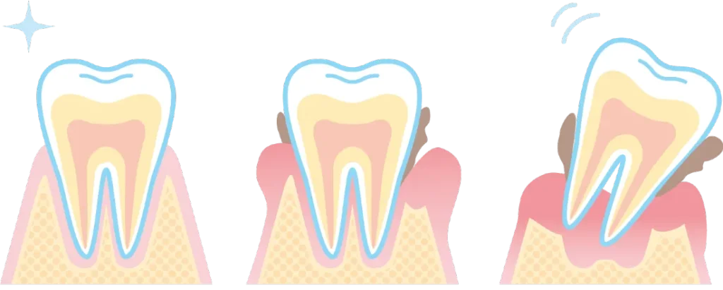 歯周病は骨が溶ける病気