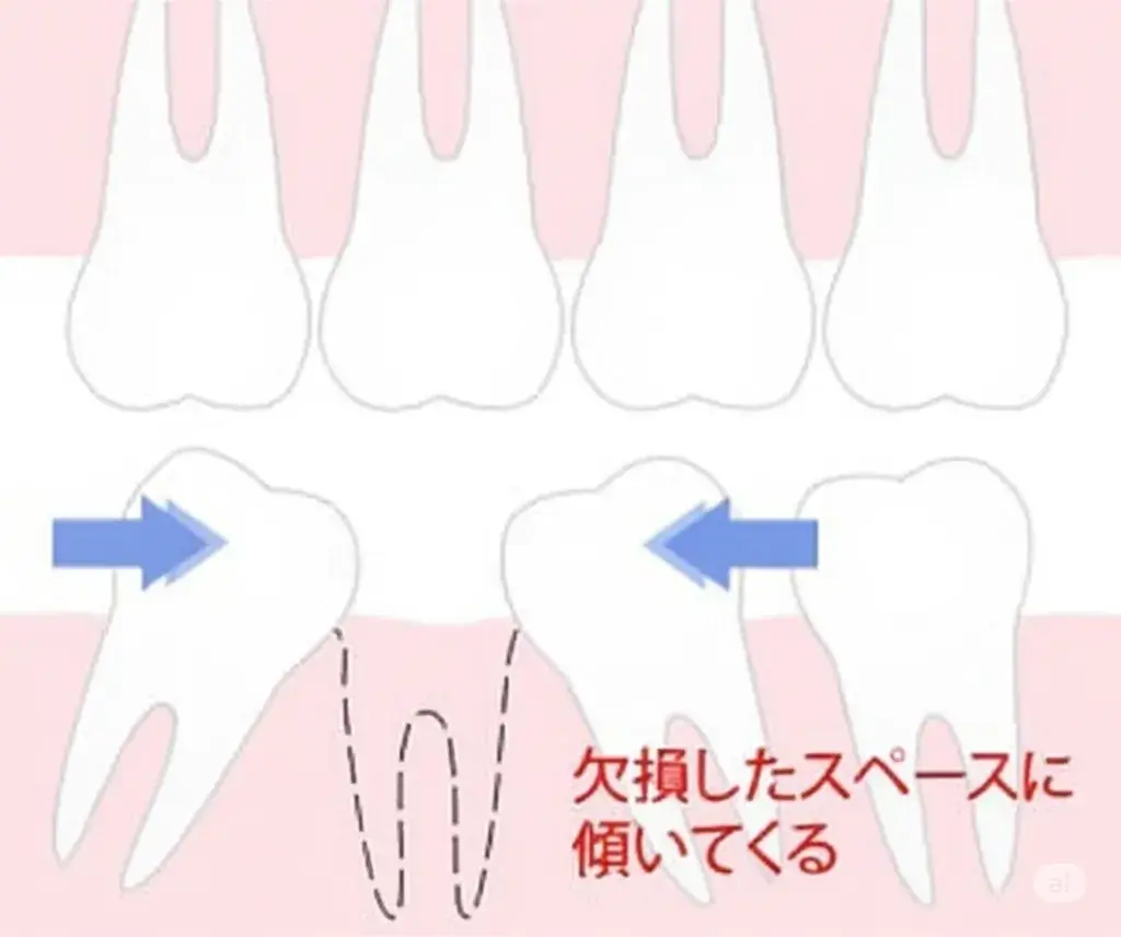 欠損した部分に歯が傾いてくる