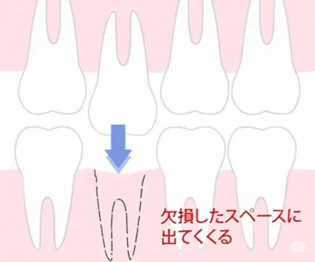 欠損した部分に歯が挺出してくる