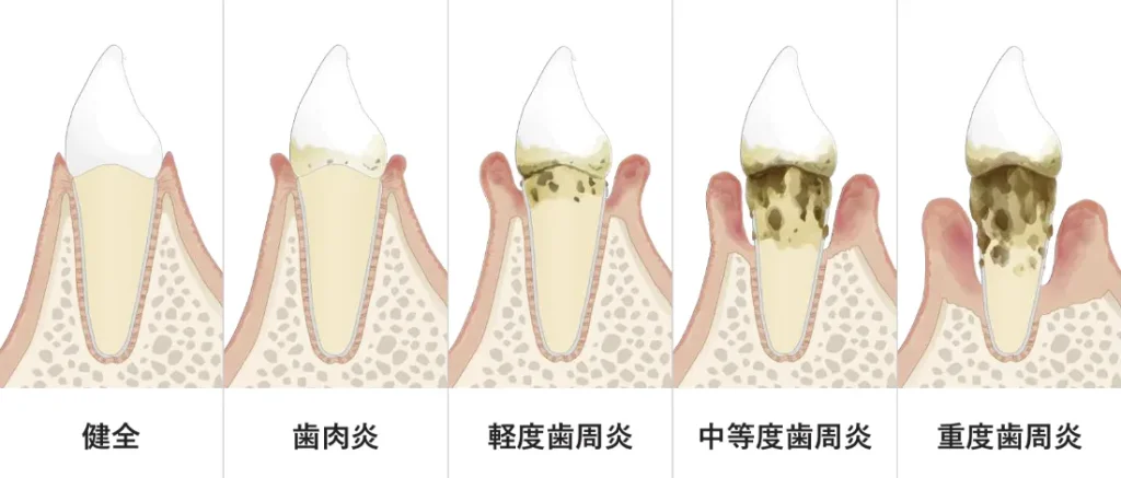 歯周病は次第に歯を支える骨が溶ける病気
