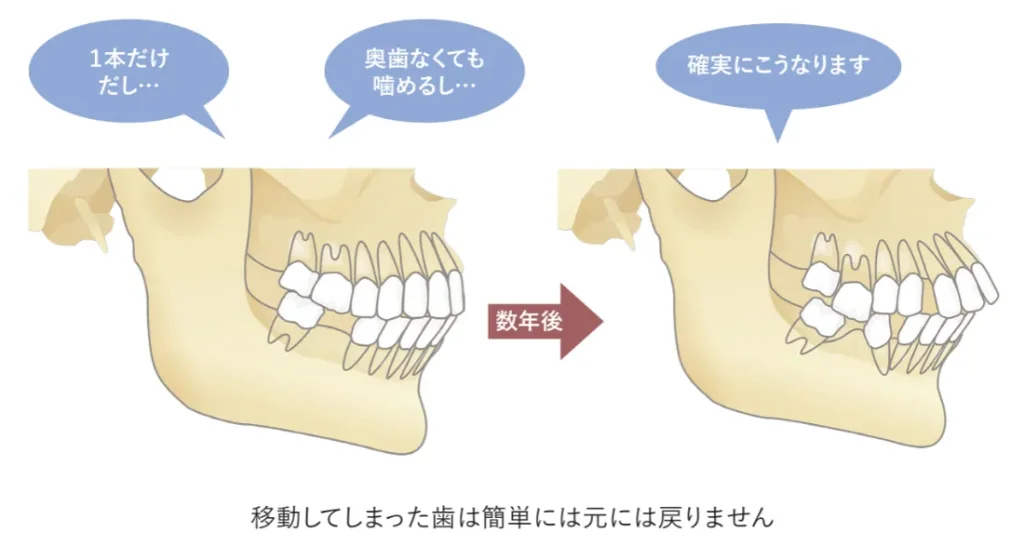 歯が抜けたまま放置してしまうと、数年後にこんな感じに・・・