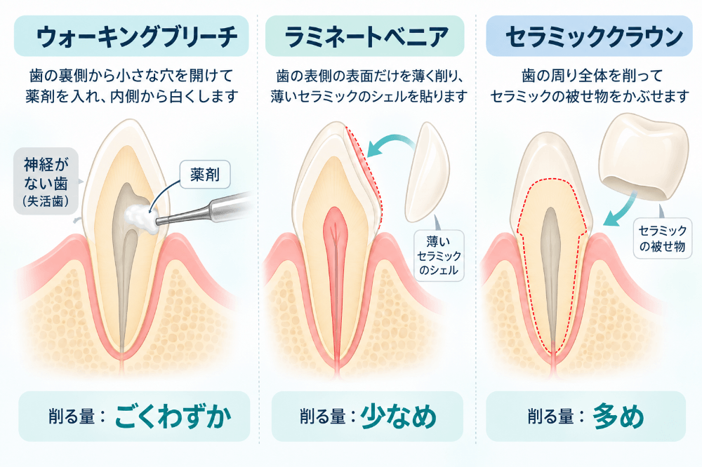 変色した歯の治療法の比較図：ウォーキングブリーチは歯をほとんど削らない、ラミネートベニアは表面を薄く削る、セラミッククラウンは歯全体を削る