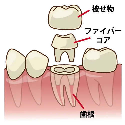 大臼歯部のファイバーコアの構成イラスト(歯根・コア・被せ物)