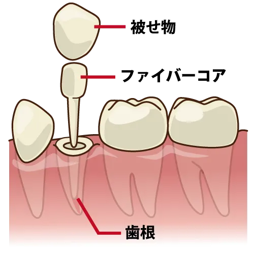 小臼歯部のファイバーコアの構成イラスト(歯根・コア・被せ物)