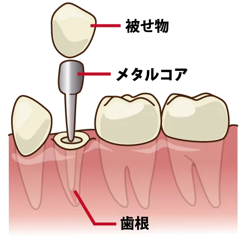 小臼歯部のメタルコアの構成イラスト(歯根・コア・被せ物)
