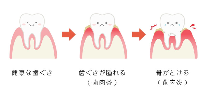 歯周病の進行度合いを表現するイラスト。左から右に行くにつれて歯周組織が退縮してくる状況。