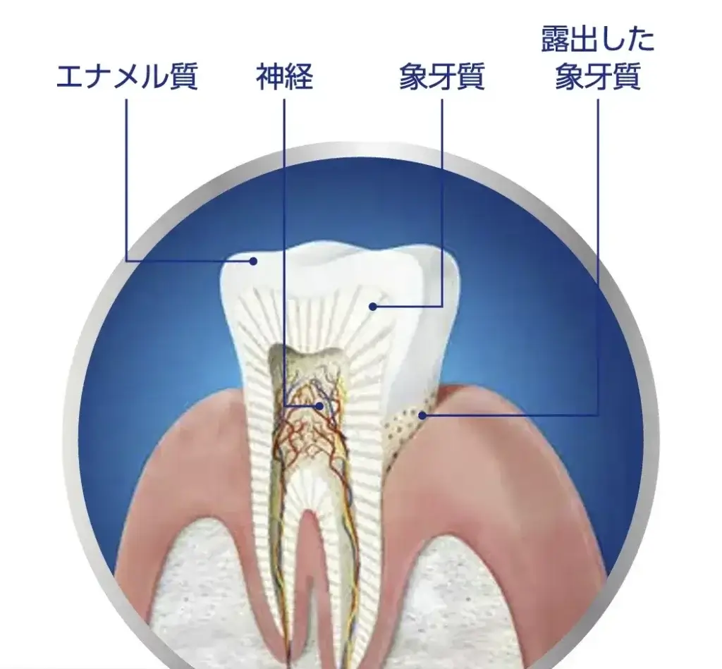 知覚過敏症のメカニズム、露出した象牙質のイラスト