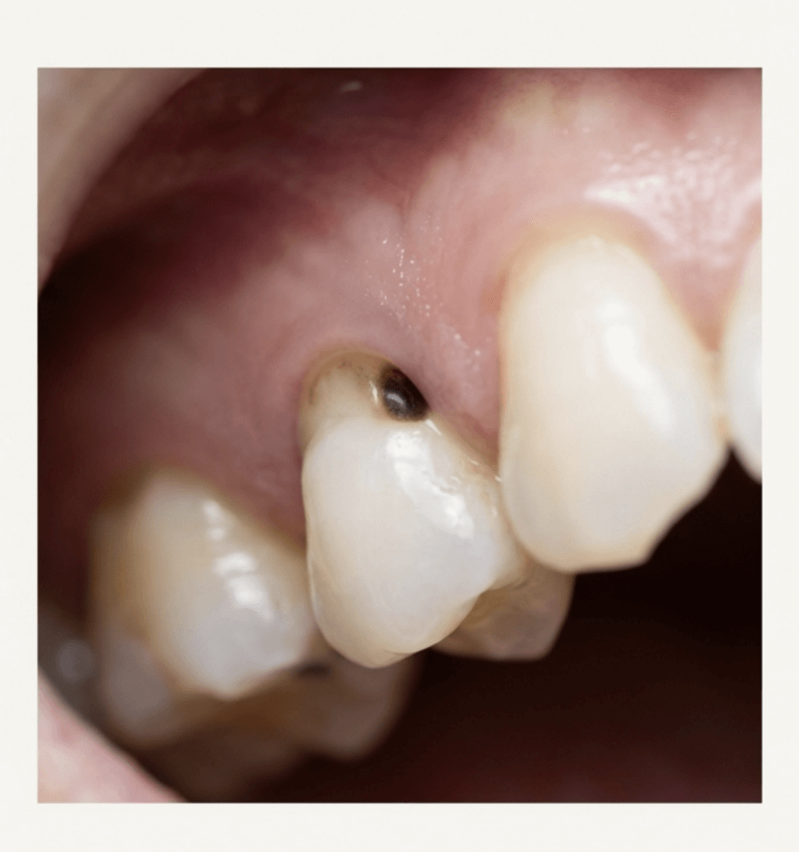 歯茎が下がり露出した歯の根元に発生した根面う蝕の口腔内写真