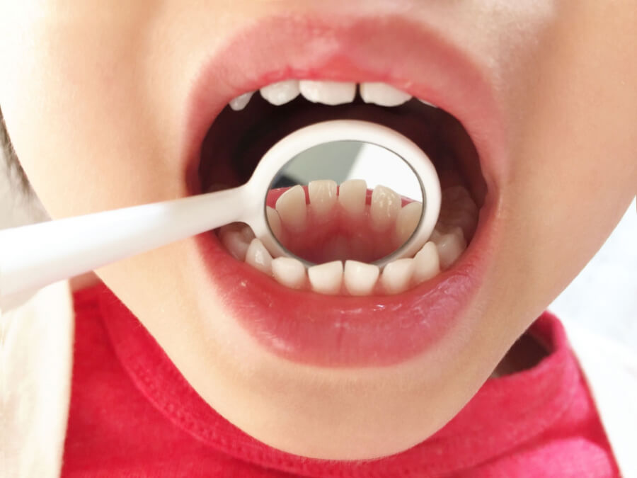 お子さんの歯のチェックと虫歯予防のための小児歯科ケアのイメージ