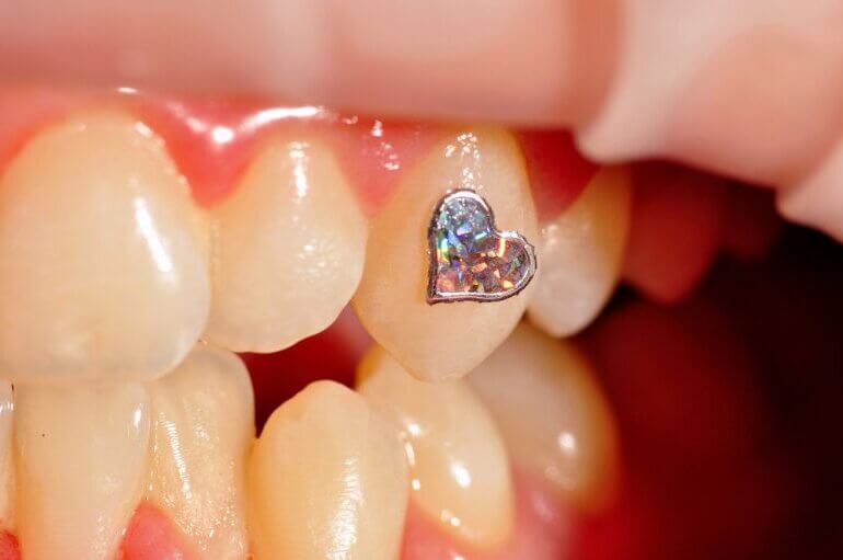 ティースジュエリー、左上の犬歯に接着後の拡大画像