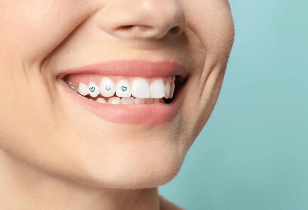 ティースジュエリーを右上に接着した口腔周囲の画像