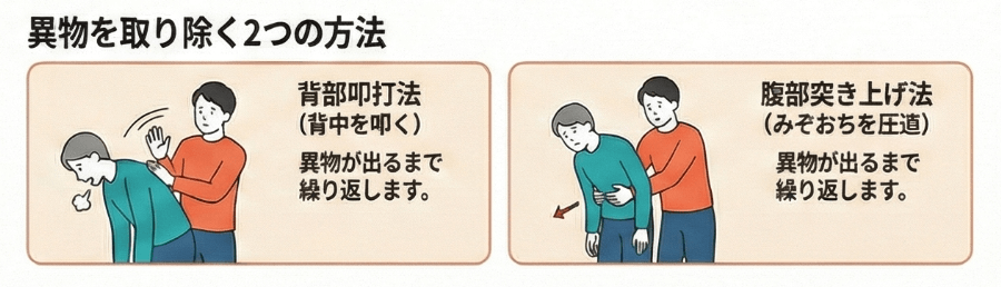 窒息時に異物を取り除く方法を示したイラスト。背中を叩く背部叩打法と、みぞおちを圧迫する腹部突き上げ法の2つの応急処置を図解している。