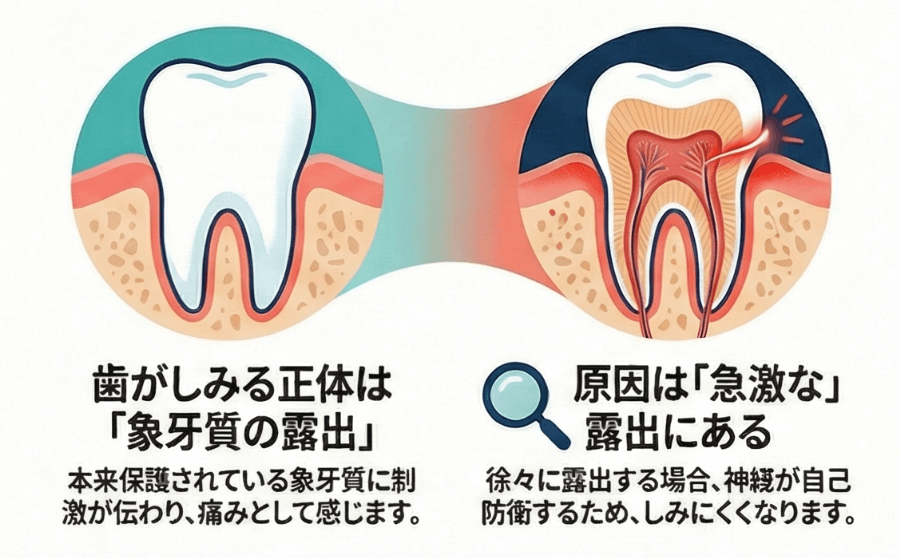 正常な歯と象牙質が露出した歯を比較し、知覚過敏が起こる仕組みを示したイラスト