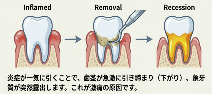 歯ぐきの炎症が治まった後に歯ぐきが下がり、象牙質が露出して知覚過敏が起こる仕組み