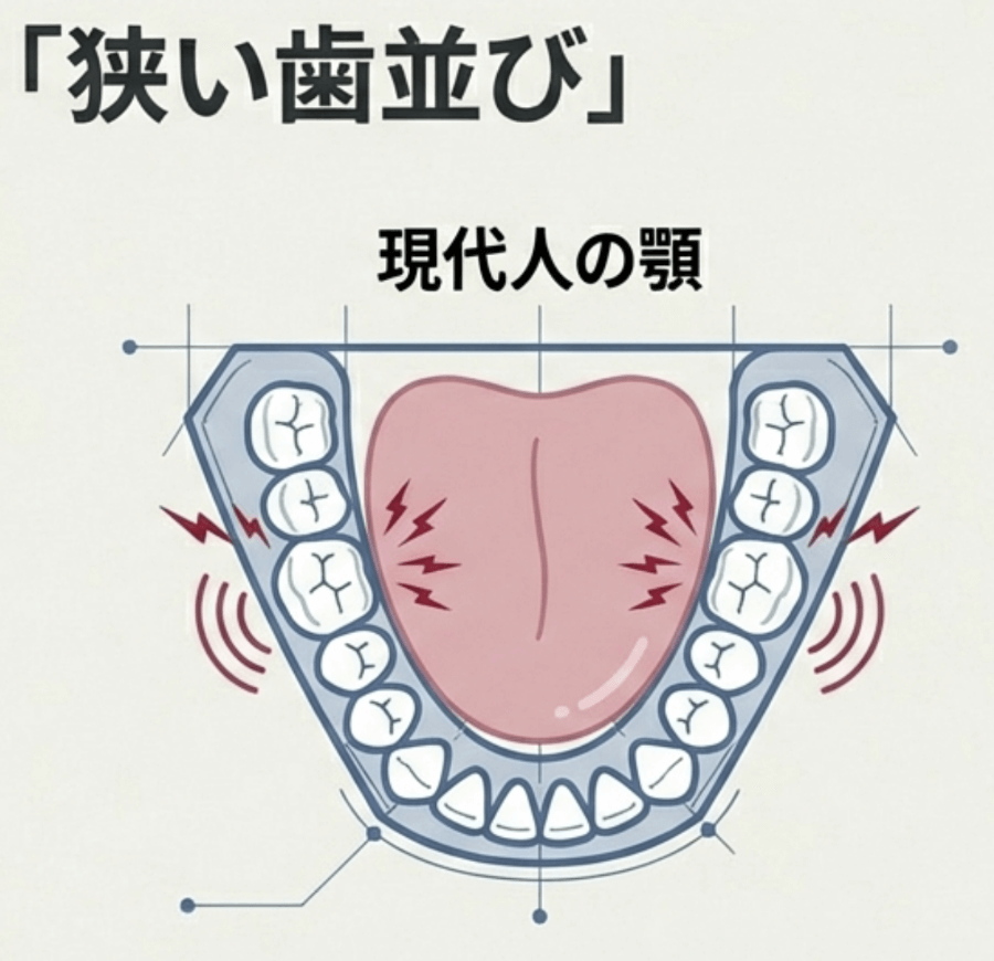 現代人に多い狭い歯並びと、舌が歯に接触しやすい状態を示した模式図