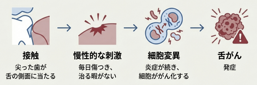 尖った歯が舌を慢性的に刺激し、細胞変異を経て舌がんに至る過程の図解