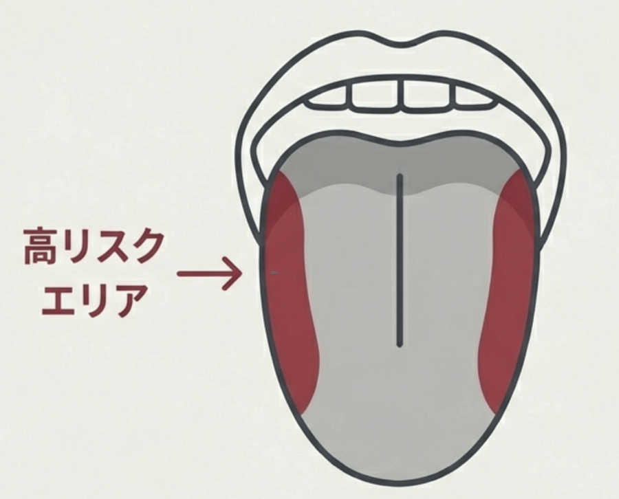 舌がんが発生しやすい舌の側面（高リスクエリア）を示したイラスト