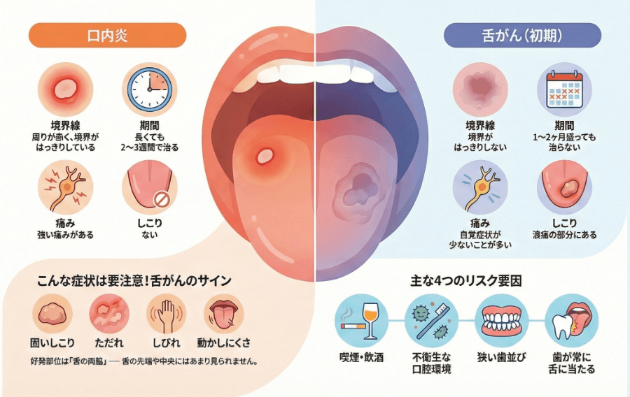 口内炎と舌がん初期の症状・リスク要因を左右で比較した総合的なイラスト