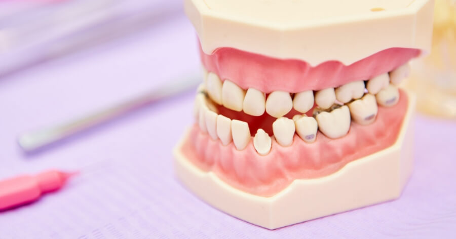 不正咬合がみられる歯列模型。噛み合わせの乱れが歯に負担をかけることを示す模型