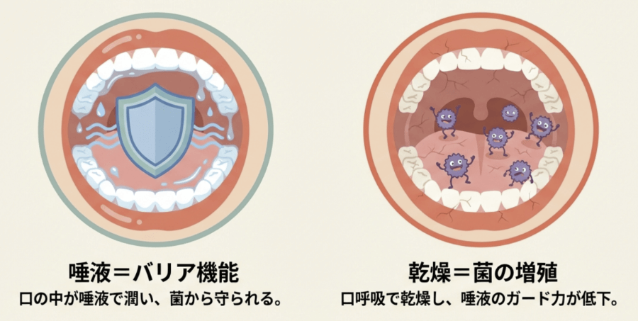唾液がある健康な口腔内と乾燥して菌が増殖した口腔内の比較図。口呼吸により虫歯・歯周病リスクが高まる様子