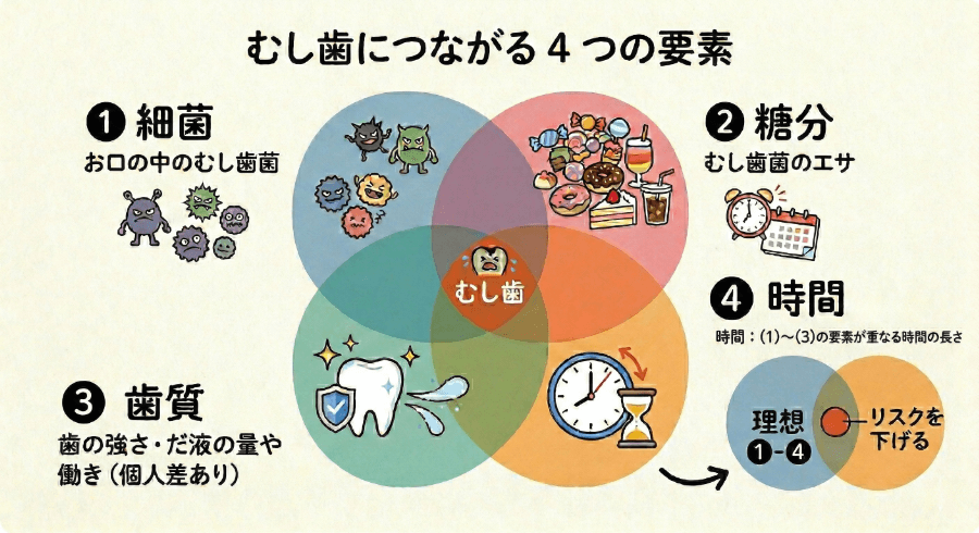 虫歯につながる4つの要素(細菌・糖分・歯質・時間)の関係を示した図