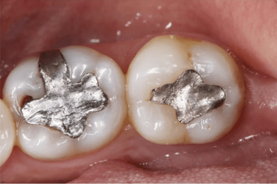 2本の奥歯にアマルガム(銀歯)が充填された口腔内の写真