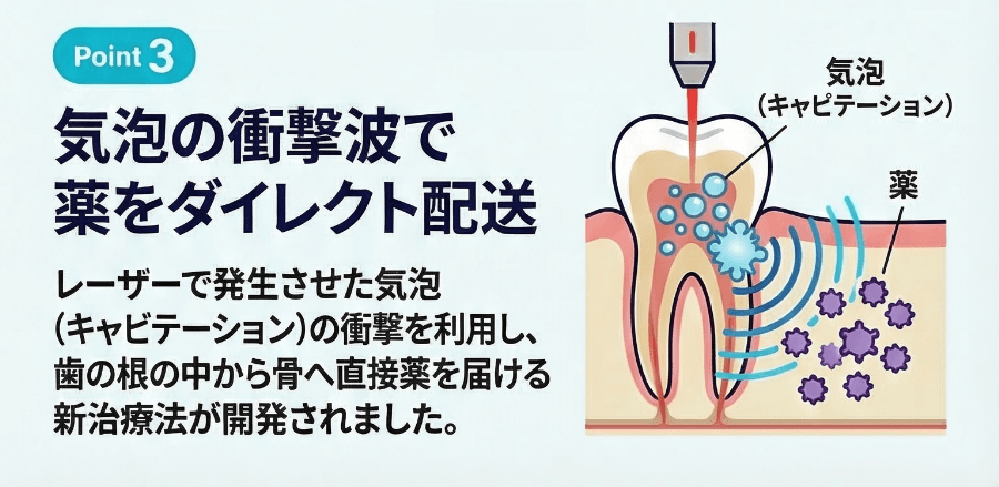キャビテーション技術で薬を歯の根から骨へ届ける新しい歯科治療のイラスト