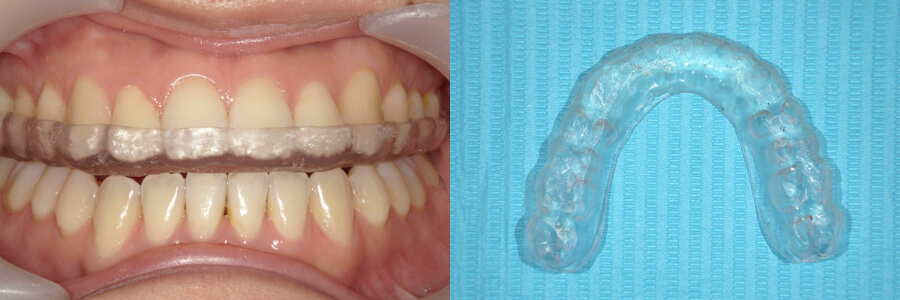 酒井歯科医院で作製したナイトガード(ハードタイプ)の装着時と取り外し時の写真