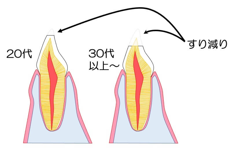 歯のすり減りを示す断面図:20代の歯と比較して30代以降の歯がすり減っている状態のイラスト