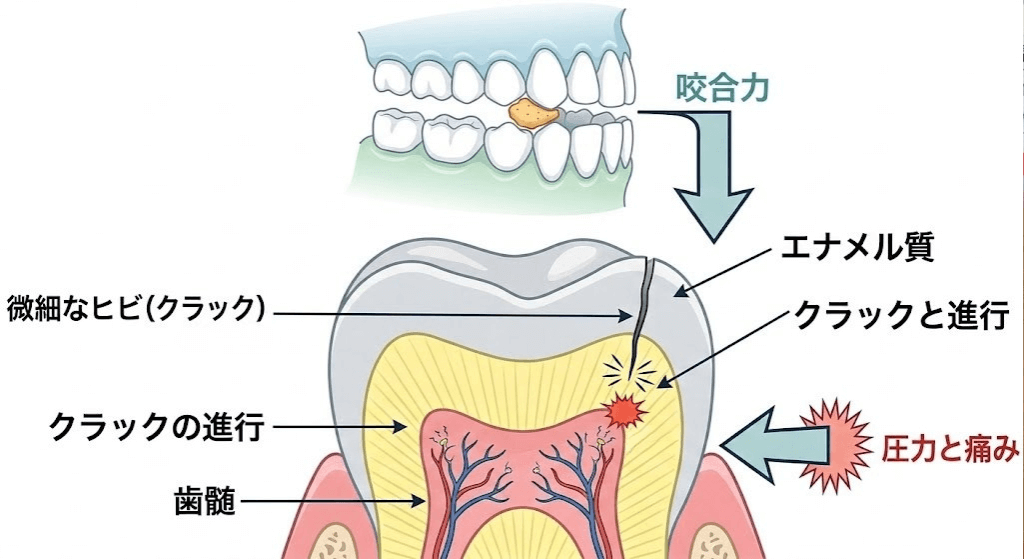 咬合力により歯にひびが入り痛みが生じるクラックトゥースの図