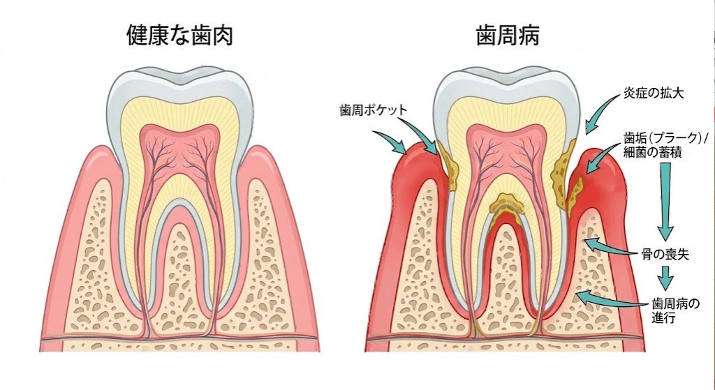 歯周病により歯ぐきと歯槽骨が破壊される進行の図