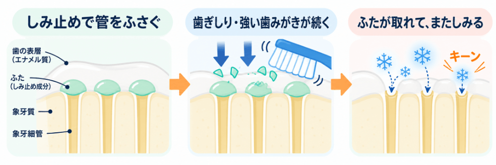 しみ止めの薬でふさいだ象牙細管の入り口が、歯ぎしりや強い歯みがきが続くことで再び開き、またしみてしまう流れを示す図