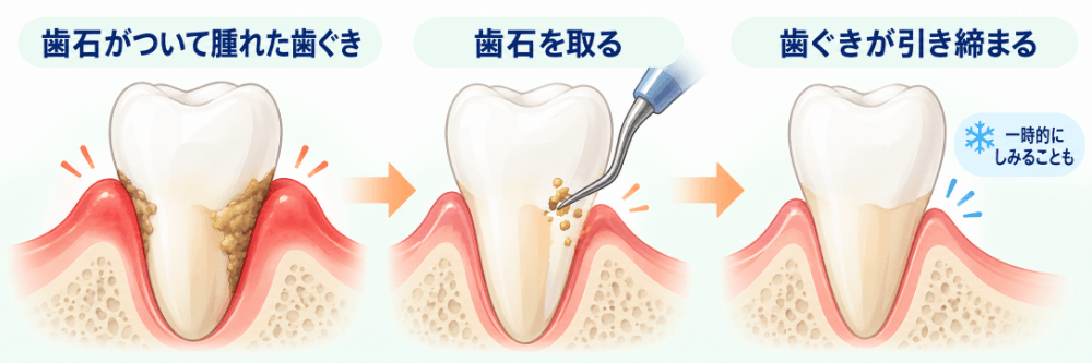 歯石を取って歯ぐきの腫れが引くと、引き締まった歯ぐきから歯の根元が見えて一時的にしみることを示す図