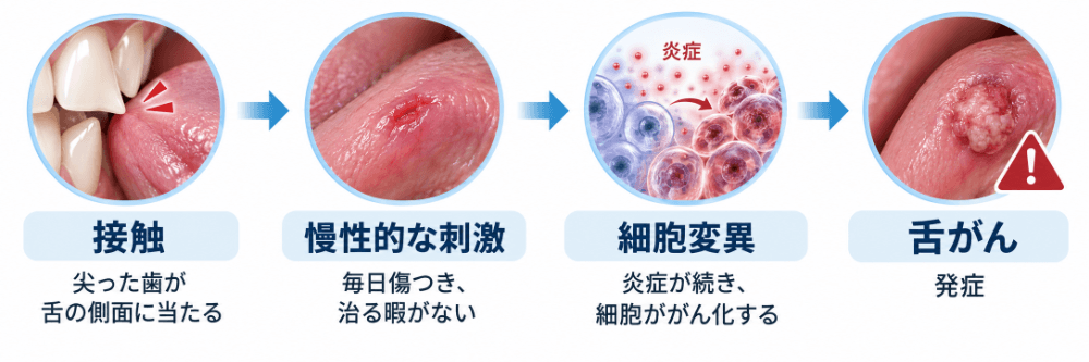 尖った歯が舌を慢性的に刺激し、細胞変異を経て舌がんに至る過程の図解