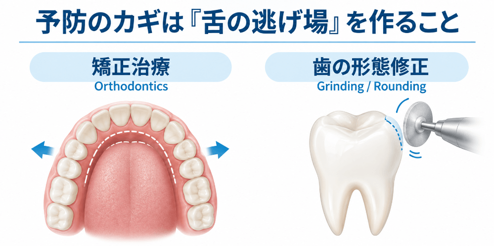 舌への刺激を減らすための矯正治療や歯の形態修正による予防方法を示した図解