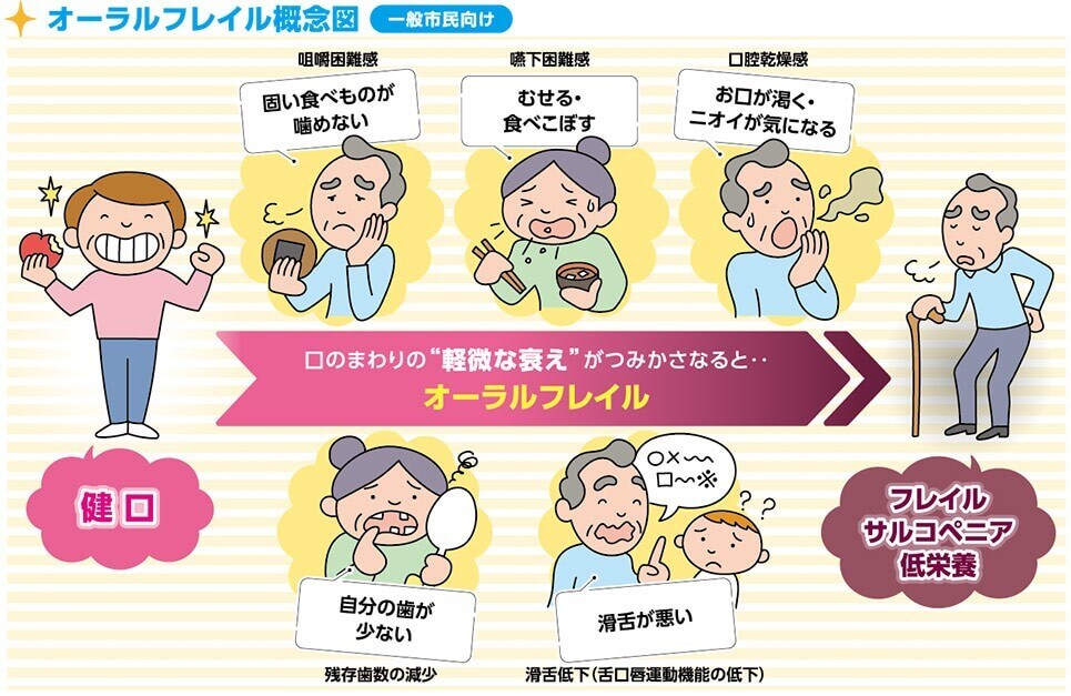 オーラルフレイルの概念図（一般市民向け）。健口（けんこう）な状態から、咀嚼困難感（固い食べものが噛めない）・嚥下困難感（むせる・食べこぼす）・口腔乾燥感（お口が渇く・ニオイが気になる）・残存歯数の減少（自分の歯が少ない）・滑舌低下（滑舌が悪い）といったお口まわりの軽微な衰えがつみ重なってオーラルフレイルとなり、放置するとフレイル・サルコペニア・低栄養へ進むことを示すイラスト