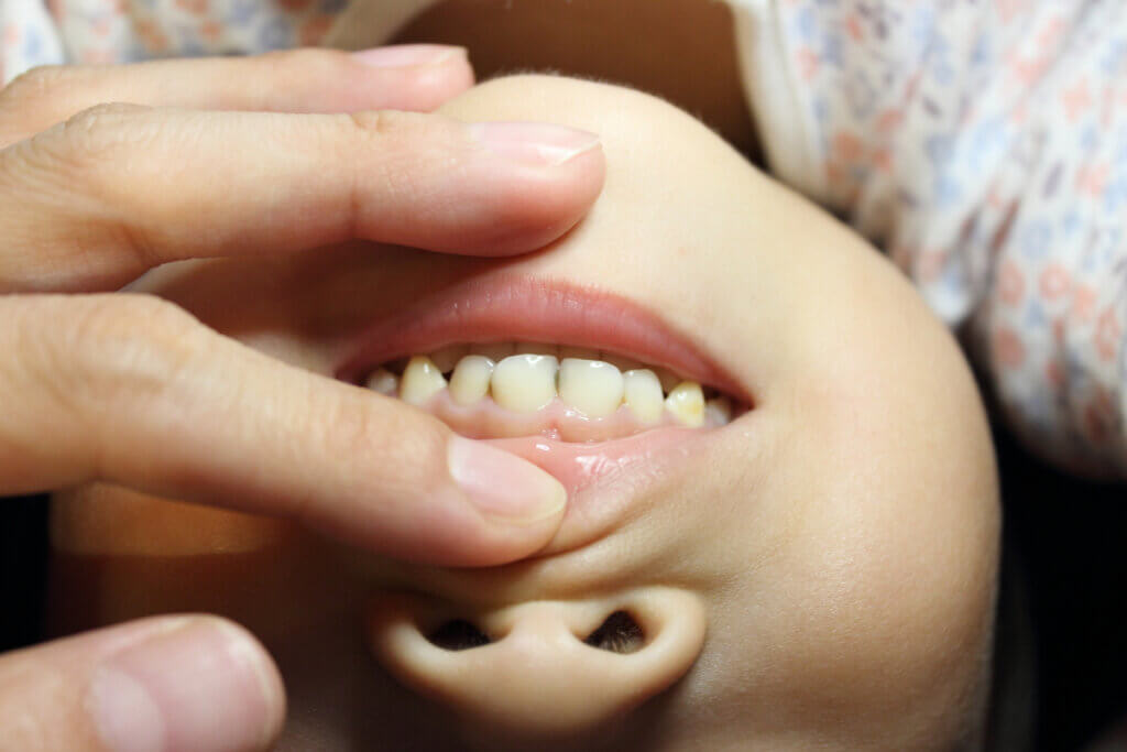 保護者に唇を広げてもらい前歯を見せる小さな子どもの口元