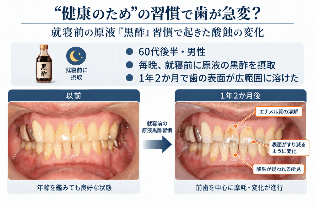 就寝前に原液の黒酢を飲む習慣で起きた酸蝕症の症例。60代後半男性の口腔内写真で、良好だった状態から1年2か月後に前歯を中心として歯の表面が広範囲に溶けた変化の比較