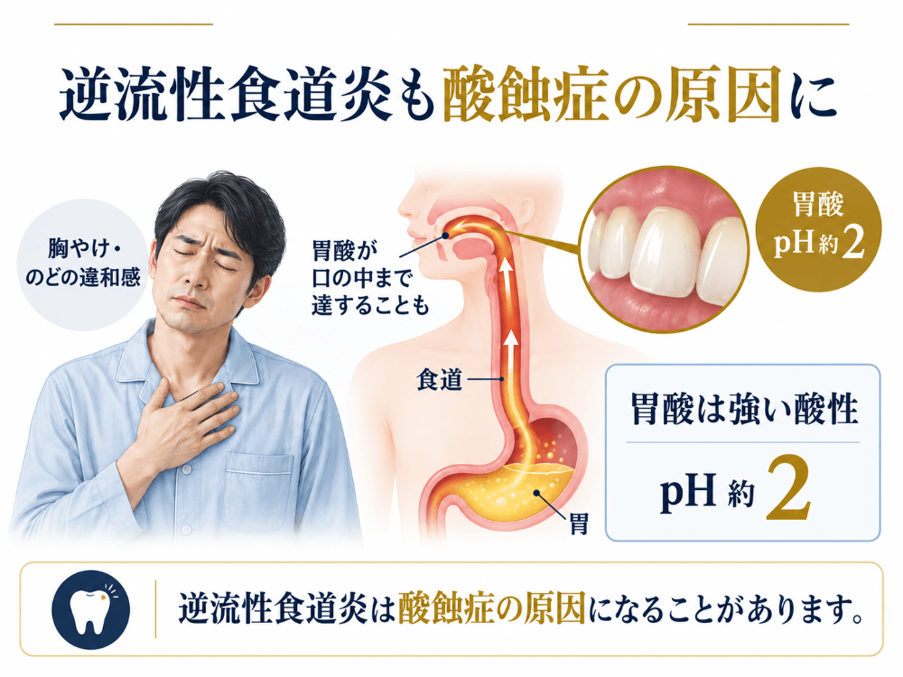 逆流性食道炎で胃酸(pH約2)が食道を通って口の中まで上がり、歯を溶かす仕組みの図解