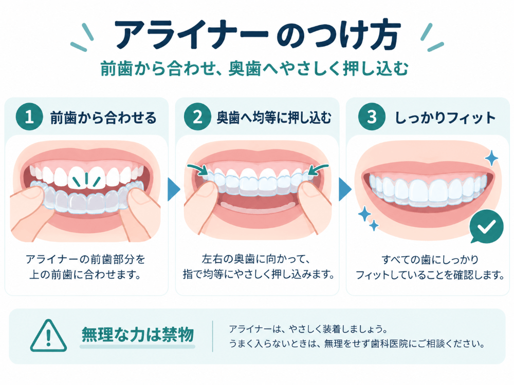アライナーの正しいつけ方の3ステップ。①前歯から合わせる②奥歯へ指で均等に押し込む③すべての歯にフィットしているか確認。無理な力は禁物