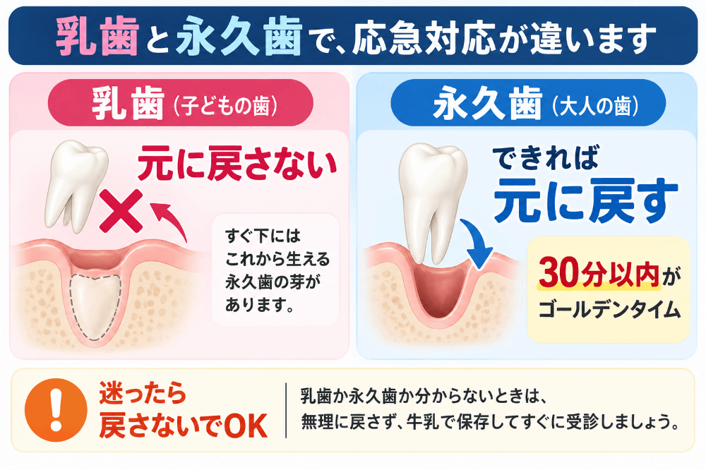 乳歯と永久歯で応急対応が違うことを示した図解|乳歯は元に戻さない、永久歯は30分以内がゴールデンタイム